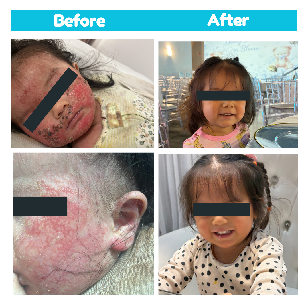 Holistic Parents Guide to Surviving Severe Eczema